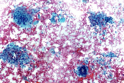 Numerous granulomas and multinucleated histiocyte (upper left).
Keywords: Granulomatous (subacute) thyroiditis