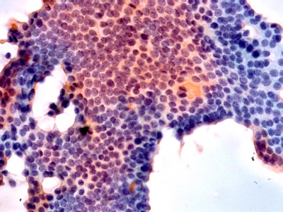 Monolayered sheet of follicular cells with nuclear elongation, chromatin clearing and nuclear grooves.
Keywords: Suspicious for Papillary Carcinoma, Susp for PTC