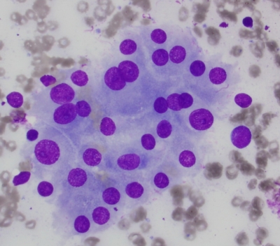 Hurthle cells (oncocytic metaplasia).
Keywords: Chronic Lymphocyte Thyroiditis (Hashimoto) Reactive Oncocytes