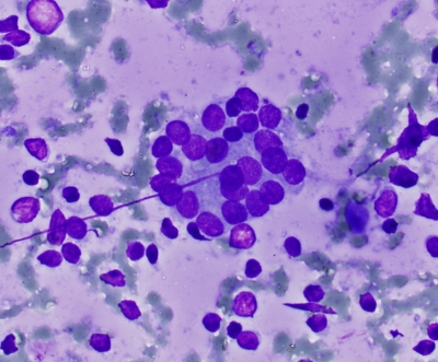 Crowded follicular cell group with lymphoid background.
Keywords: Chronic Lymphocytic Thyroiditis (Hashimoto) microfollicle