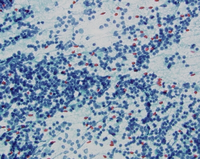 Mixed lymphoid population without Hurthle cells
Keywords: Chronic Lymphocytic Thyroiditis (Hashimoto) without Hurthle cells