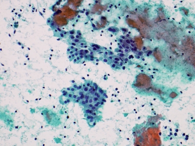 Lymphocytes and Hurthle cells (oncocytic metaplasia)
Keywords: Chronic Lymphocytic Thyroiditis (Hashimoto) lymphocytes Hurthle cells oncocytes