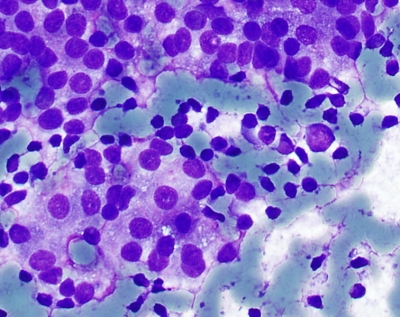 Sheets of Hurthle cells and lymphocytes.
Keywords: Chronic Lymphocytic Thyroiditis (Hashimoto)
