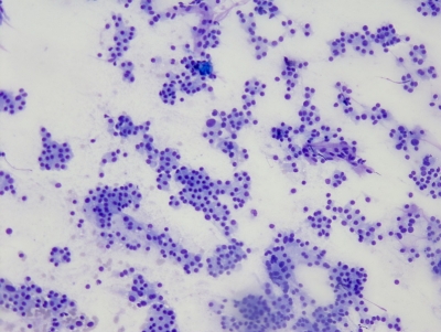 Very cellular specimen with numerous microfollicles and minimal colloid.
Keywords: Follicular Neoplasm