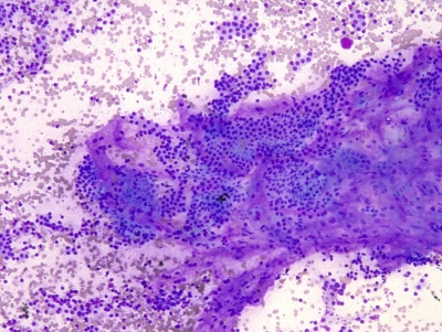 Benign follicular cells.
Keywords: Adenomatoid Nodule, Cellular Goiter, Cellular nodule, adenomatous hyperplasia in colloid goiter