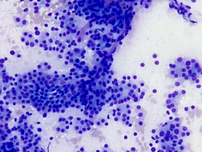 Very cellular specimen with numerous microfollicles and minimal colloid.
Keywords: Follicular Neoplasm