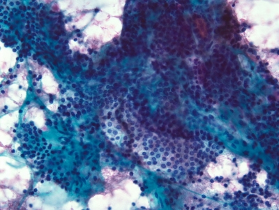 Benign follicular cells in sheets.
Cellular portion of adenomatoid nodule (cellular colloid goiter). 
Keywords: Adenomatoid Nodule, Cellular Goiter, Cellular nodule, adenomatous hyperplasia in colloid goiter