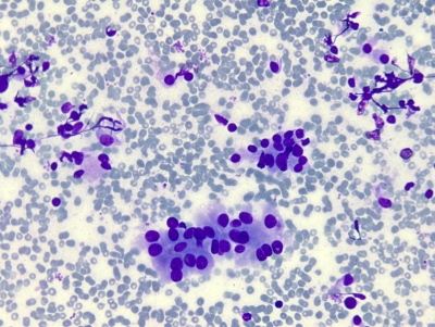 Hurthle cells with rare crushed lymphocytes.
Keywords: Hashimoto, Autoimmune, Chronic Lymphocytic Thyroiditis