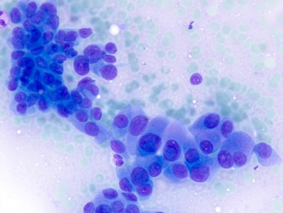 Papillary carcinoma with cellular crowding.
Keywords: Papillary Carcinoma