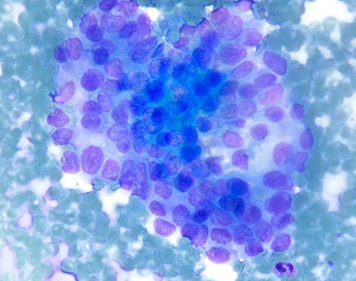 Papillary thyroid carcinoma. Note nuclear grooves.
Keywords: Papillary Carcinoma, Classic, Nuclear Grooves