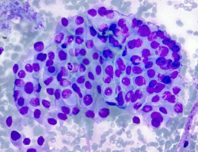 Papillary thyroid carcinoma. 
Keywords: Papillary Carcinoma, Classic, Nuclear Grooves