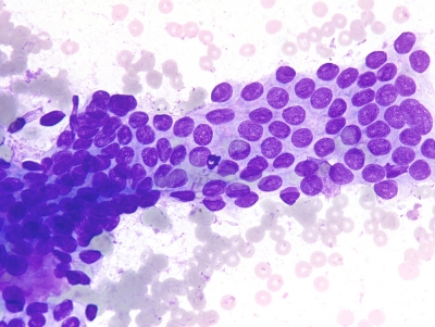 Papillary thyroid carcinoma. Note the nuclear grooves.
Keywords: Nuclear Grooves
