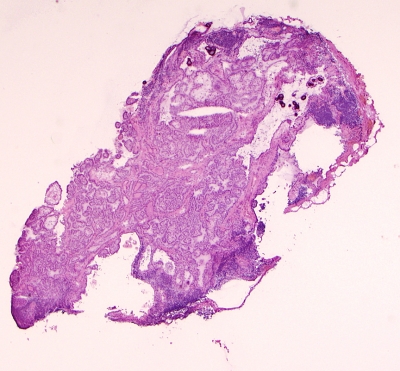 Papillary Carcinoma of Thyroid-Frozen Section. (Low Power.)
Low power view of papillary carcinoma in frozen section. Note the psammoma bodies and papillary architecture.
Keywords: Papillary Carcinoma, Frozen Section, Low Power