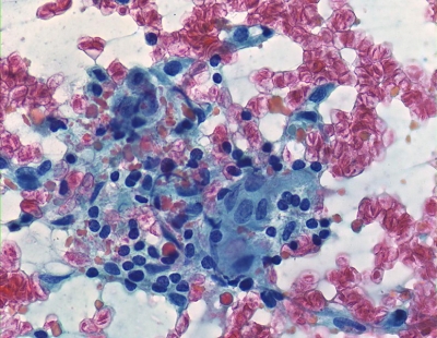 Small cluster of epithelioid histiocytes and some follicular cells.
Keywords: Granulomatous (subacute) Thyroiditis