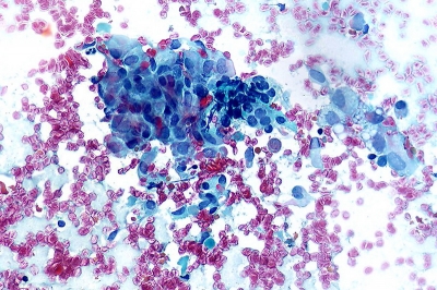 Small cluster of epithelioid histiocytes and some follicular cells.
Keywords: Granulomatous (subacute) Thyroiditis