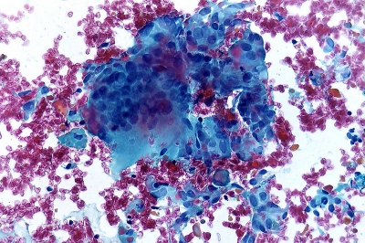 Granuloma with multinucleated giant cell.
Keywords: Granulomatous (subacute) thyroiditis, Multinucleated Giant Cell