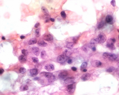 Sparsely cellular specimen with large pleomorphic cells.
Keywords: Suspicious for Neoplasm