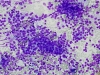Chronic_lymphocytic_thyroidoitis-Mixed_lymphocytes,_oncocytes,_follicular_cells-dq-medium-crothers-1.jpg