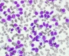 Hashimotos,_intermediate_size_lymphocytes,_hp_DQ_SM.jpg