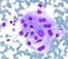 Hashimotos,_oncocytes,_DQ_hp_SM.jpg