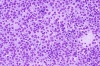 Large_Cell_Lymphoma_2~0.jpg