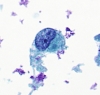 Met_PD_breast_CA_to_thyroid,_huge_cell,_PAP.jpg