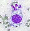 Met_PD_breast_CA_to_thyroid,_huge_cell_with_vacuoles,_DQ.jpg