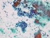 chronic_lymphocytic_thyroiditis-Hurthle_cells_and__lymphocytes-pap-medium-zhang.jpg