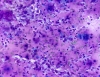 subacute_granulomatous_thyroiditis-epithelioid_histiocytes_forming_granulomas_in_a_background_contianing_colloid-dq-medium-ali.JPG
