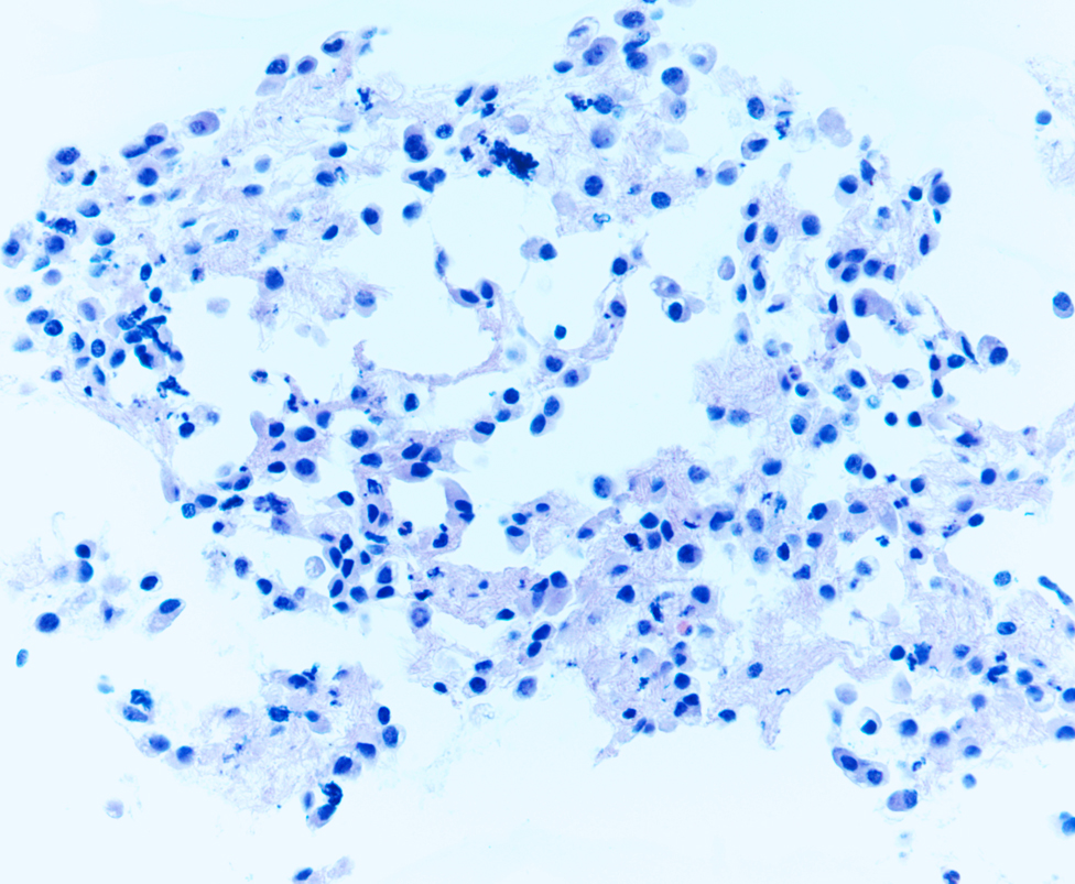 Papanicolaou Society of Cytopathology Case of the Month April 2012