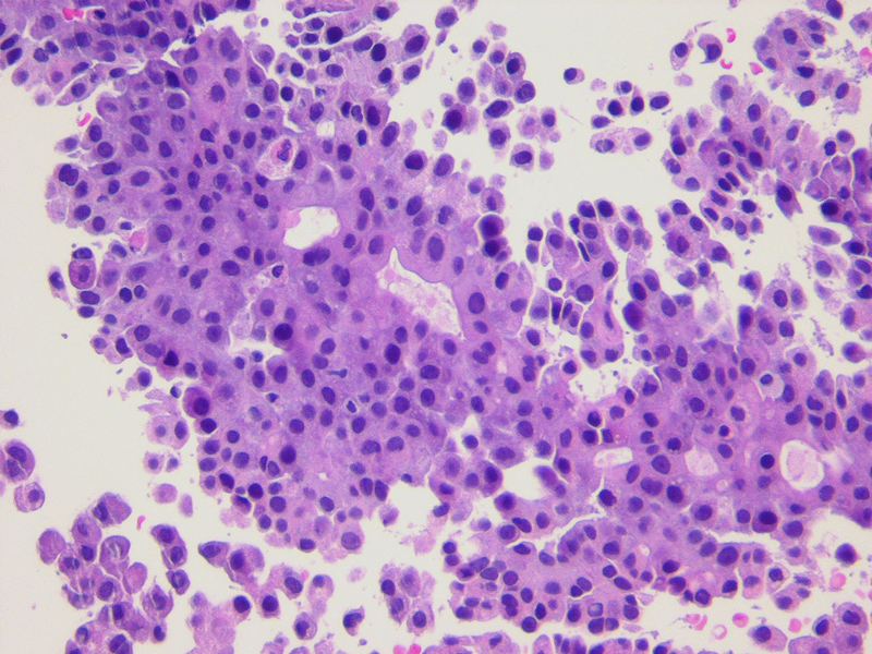 Papanicolaou Society of Cytopathology Case of the Month September 2012